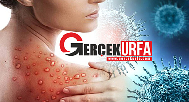 Sağlık Bakanlığı Açıkladı! Maymun Çiçeği Virisünde Merak Edilen Sorular