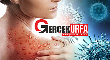 Türkiye'de Maymun Çiçeği Vakası Görüldü İddiasına İlişkin Açıklama