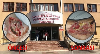 Şanlıurfa’da Tıbbi Mucize Doktorun Azmi Bacağı Kurtardı!