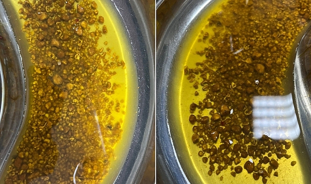 Doktorlar Hayrete Düştü Safra Kesesinden 2 Bin 67 Taş Çıktı!