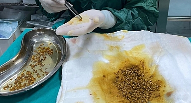 Doktorlar Hayrete Düştü Safra Kesesinden 2 Bin 67 Taş Çıktı!